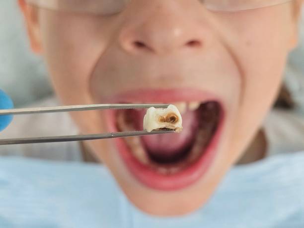 Best Emergency Dentist for Lost Fillings or Crowns in St James, MD